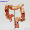 PNT-07451 Modelo intestinal humano Disease Large Intestines model for education